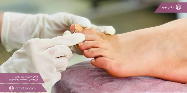 Toenail-surgery-with-laser-a-non-invasive-method-without-pain-and-bleeding