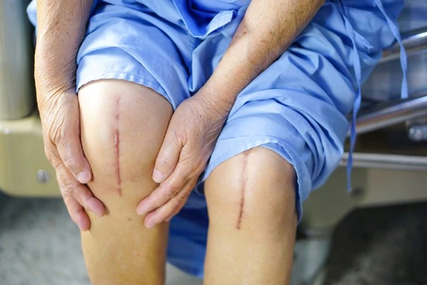 Arthritis-knee