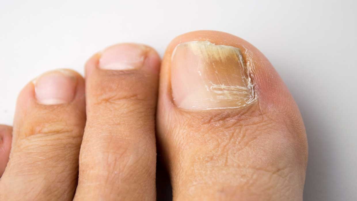 عوارض کشیدن ناخن شست پا و روش های درمان آن