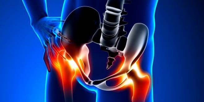 التهاب استخوان لگن، سبب درد در ناحیه کشاله ران، درد درون مفصل ران، مشکل در راه رفتن یا دویدن