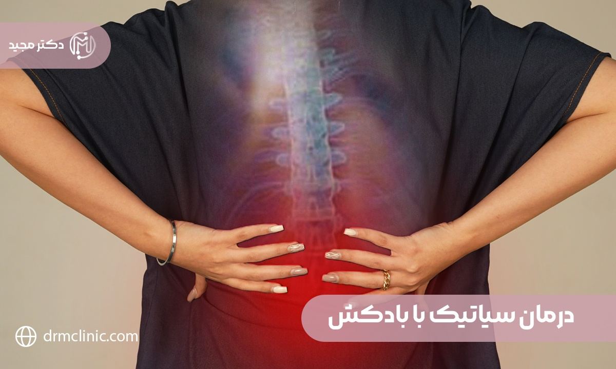 درمان سیاتیک با بادکش