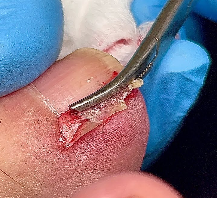 درمان عارضه ناخن پا در بهترین کلینیک جراحی ناخن پا