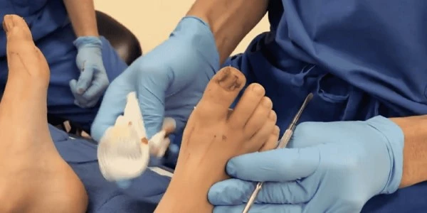 Surgery-insert-nail-into-flesh-foot