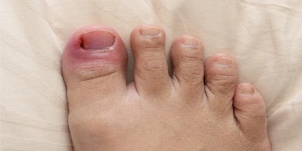 Toe-infection