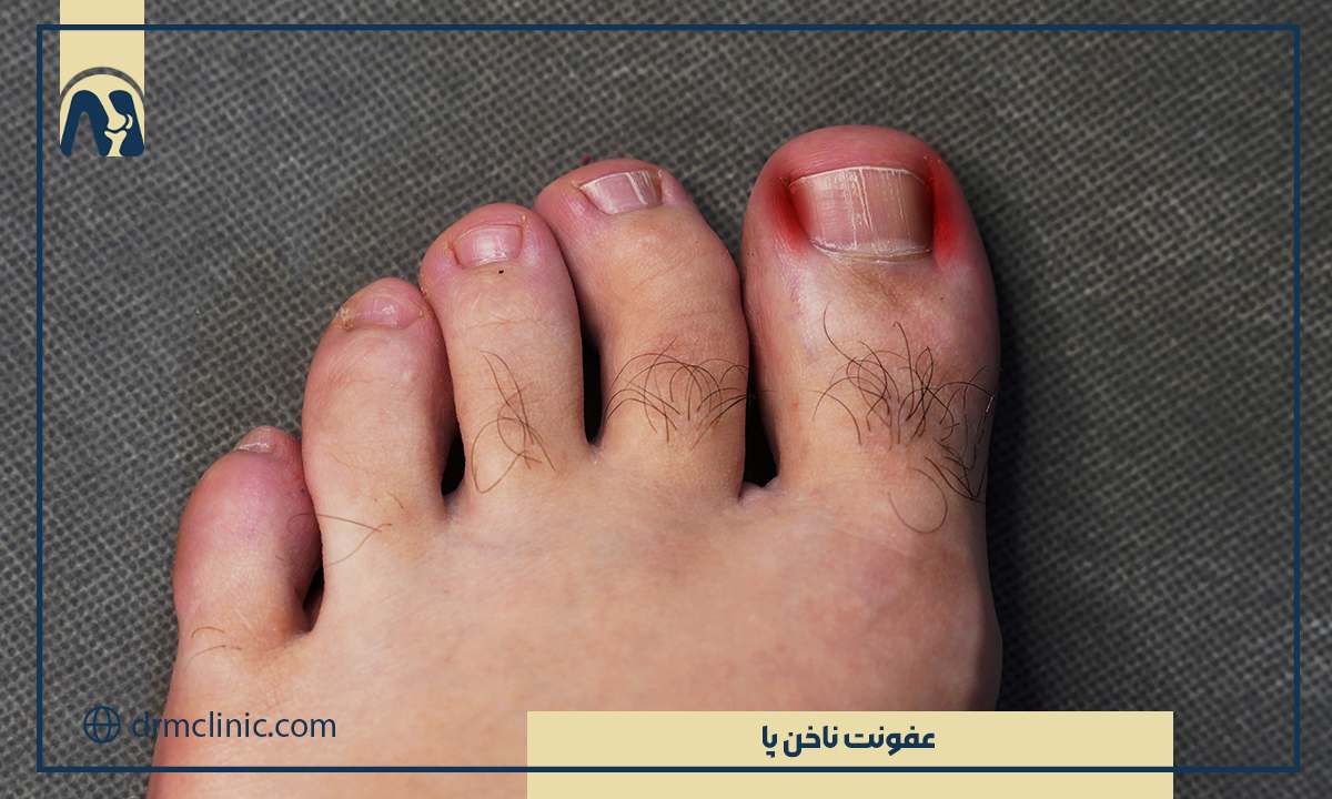 عفونت ناخن پا