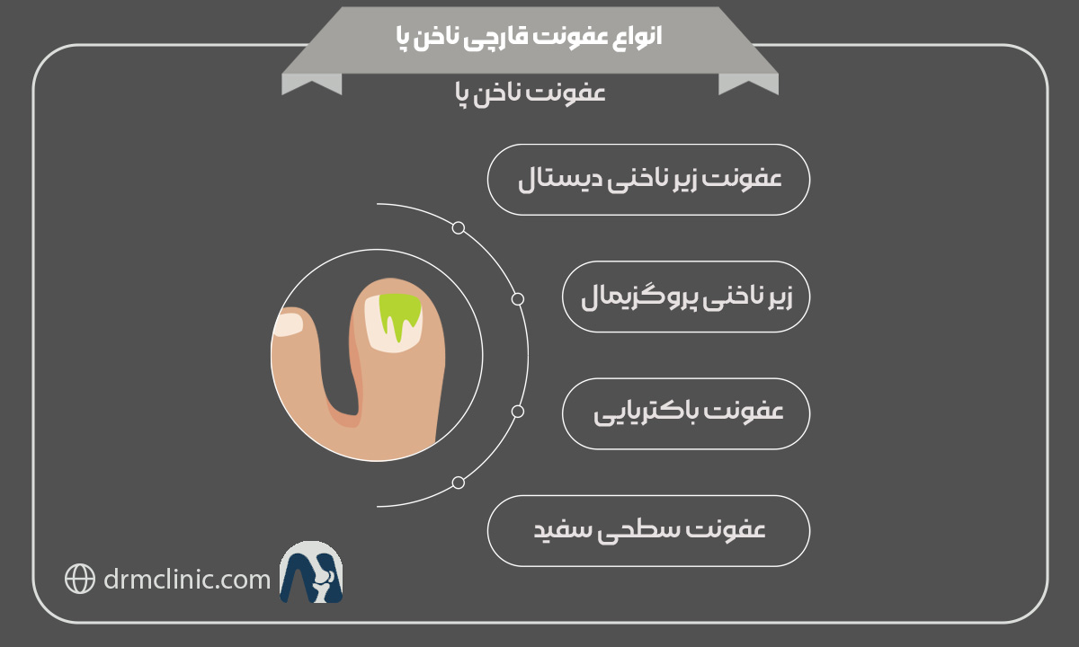 انواع عفونت قارچی ناخن پا