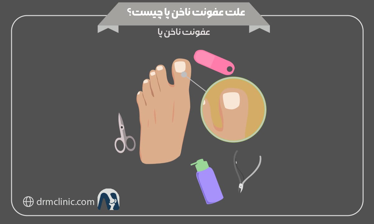 علت عفونت ناخن پا چيست؟