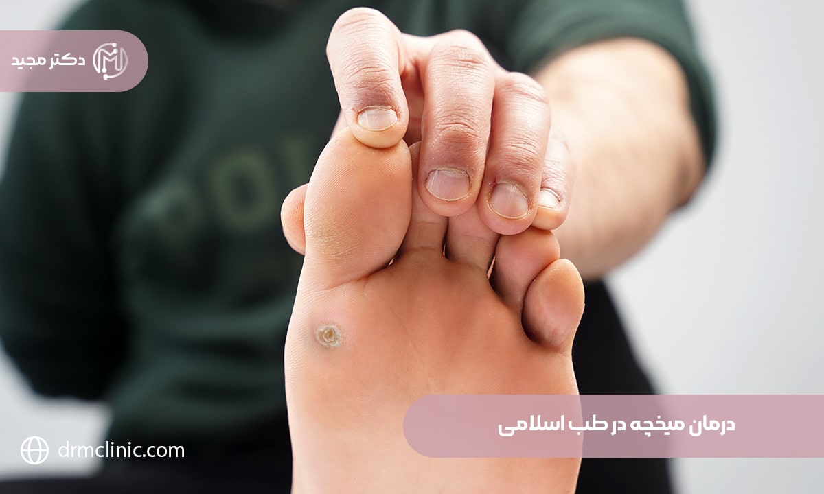 درمان میخچه با شیره درخت انجیر