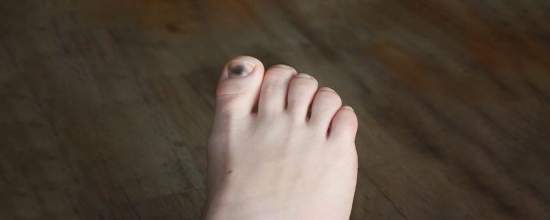 درمان سیاه شدن ناخن پا در اثر ضربه، راه‌ های تشخیصی و درمانی؟
