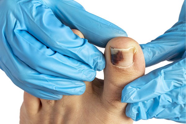 آیا برای درمان سیاه شدن ناخن پا باید آن را به طور کامل برداشت؟