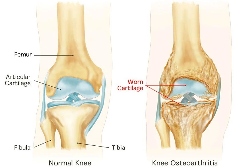 Treatment-knee-arthritis-traditional-medicine