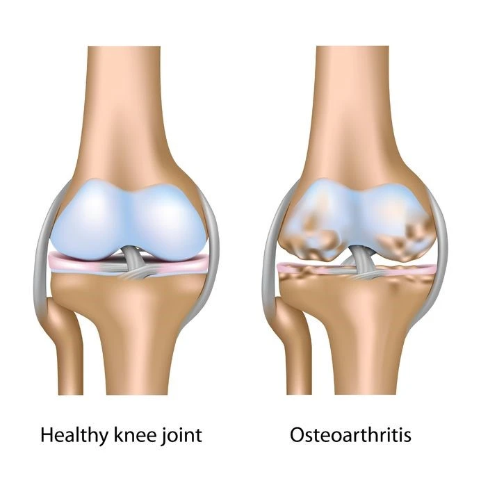 Treatment-knee-arthritis