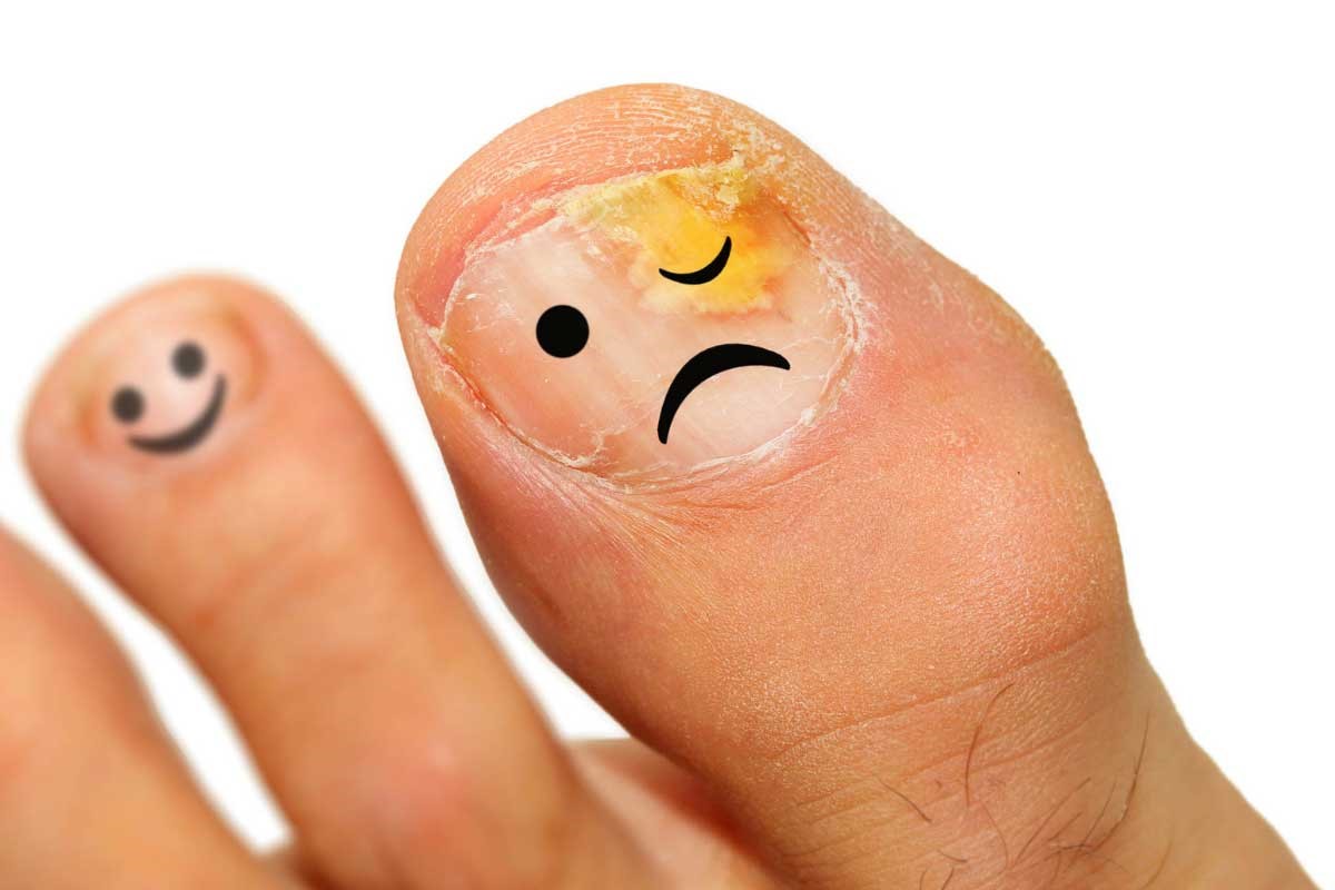 زرد شدن ناخن پا نشانه چیست و چگونه آن را درمان کنیم؟
