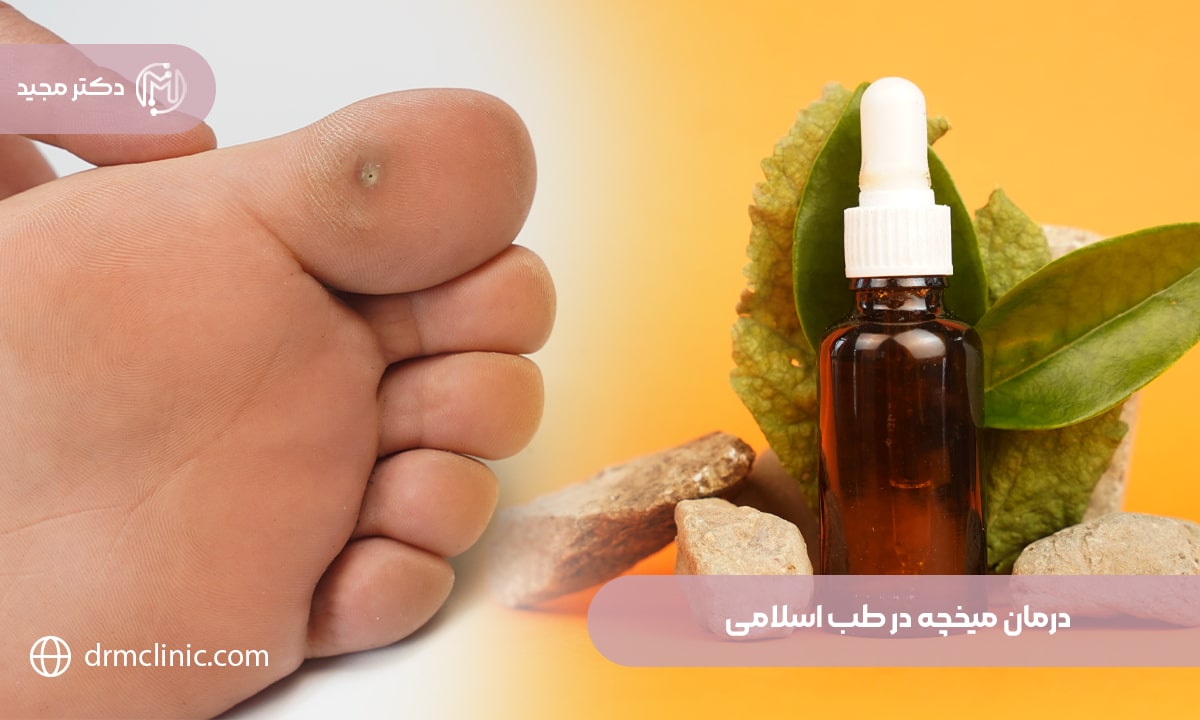 درمان میخچه در طب اسلامی