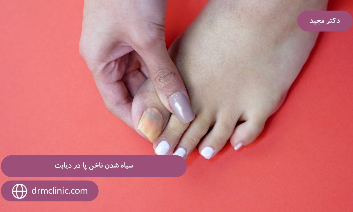 سیاه شدن ناخن پا در دیابت 